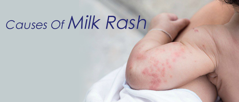 Causes Of Milk Rash Cussons Baby Ghana